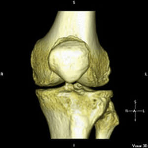 Knee prosthesis design software - iFit® - ConforMIS - anatomy / orthopedic surgery