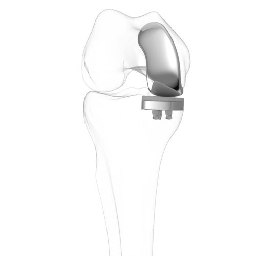 Unicondylar knee prosthesis - iUni®  - ConforMIS - fixed-bearing / cemented