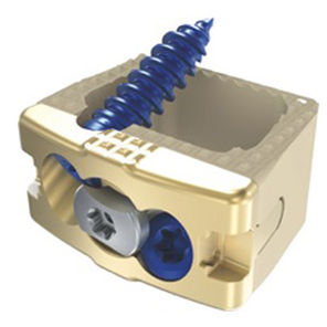 Cervical interbody fusion cage - Vault%u2122%uFEFFC - Precision Spine - anterior / titanium / PEEK