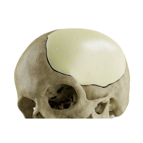 Custom-made cranial implant - CROWN  - EUROS