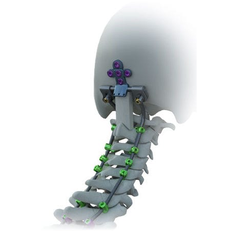 Occipito-cervical osteosynthesis unit - Avalon® - Alphatec Spine - posterior / adult