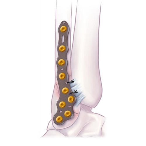 Fibula compression plate - VOLITION™  - Ortho Solutions - malleolus / distal / lateral