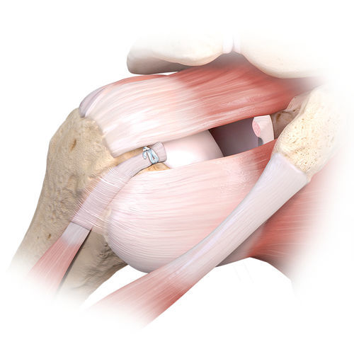 Rotator Cuff Suture Anchor Tack™ Arthrex Non Absorbable