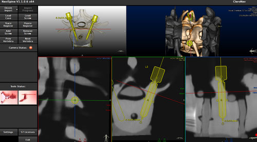 Surgical navigation software - NAVIX - Claron Technology - for robotic-assisted surgery / spine