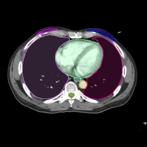 Medical imaging AI platform - Contour ProtégéAI® - MIM Software - contouring / standardization