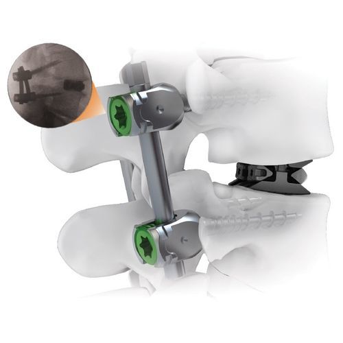 Thoraco-lumbar osteosynthesis unit - CENTERLINE® - Life Spine - posterior / adult