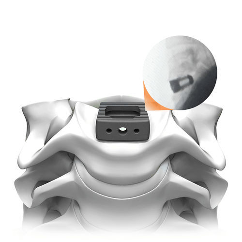 Cervical interbody fusion cage - PLATEAU®-C Ti - Life Spine - anterior / titanium
