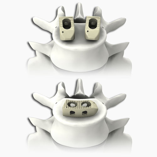 Lumbar interbody fusion cage PLATEAU® Life Spine posterior