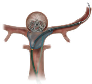Blood vessel catheter - Scepter XC® - MicroVention - balloon / hydrophilic