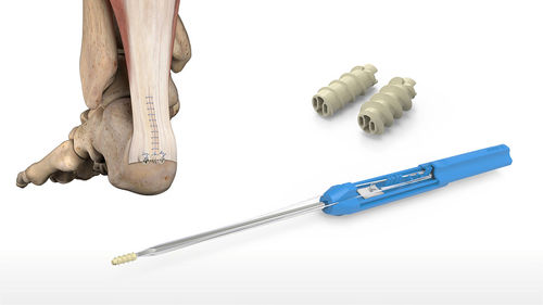 Calcaneal tendon suture anchor - 46-0008-S - Acumed - talo-calcaneal ligament / non-absorbable