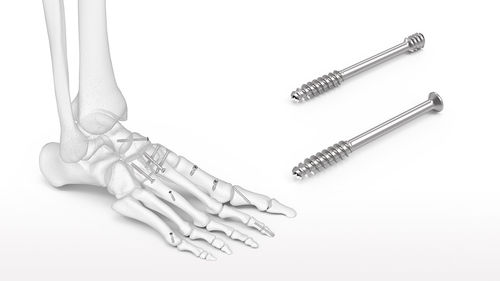 Hindfoot compression bone screw - ExtremiFix™ - Acumed - ankle / cannulated / headless