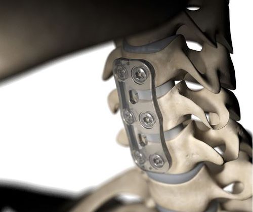 Cervical vertebra arthrodesis plate - S-1™ - Inion - bioresorbable polymer / 2 levels / 1 level