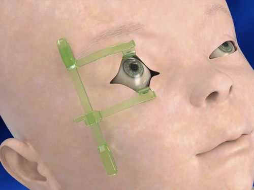 Eyelid speculum - Neotech Products - pediatric / single-use