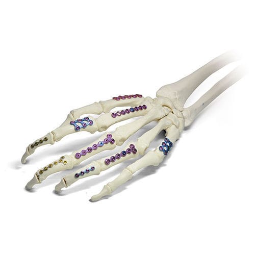 Hand phalange compression plate - SIGNEX - OSTEONIC - locking / metallic