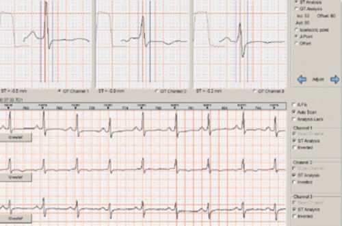Analysis software - Braemar C1000   - Braemar - for cardiac Holter monitors