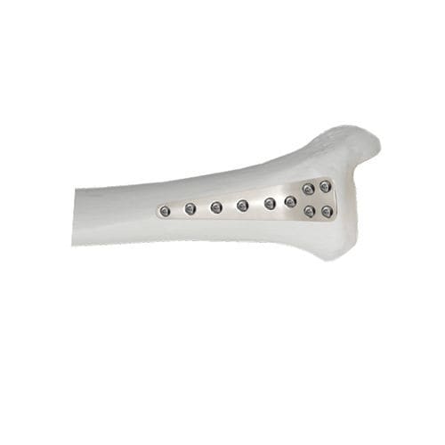 Tibia compression plate - 37.804 series - Medicalex - distal / anterolateral / locking