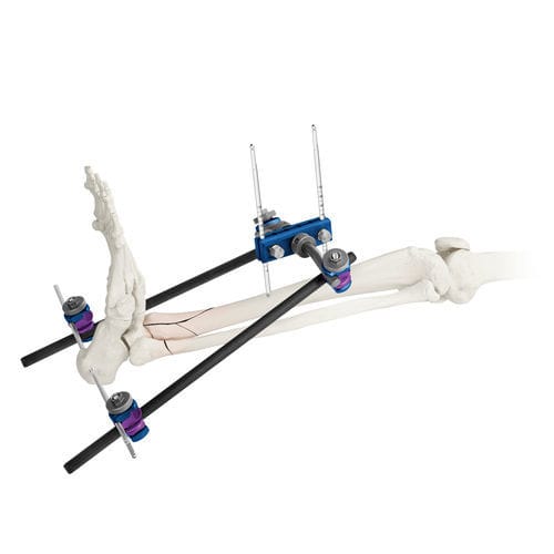 Ankle external fixation system - ARBOR® - Globus Medical - tubular / adult