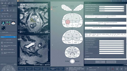 Analysis software module - Myrian® XP-Prostate - Intrasense - visualization / for MRI / for ultrasound imaging