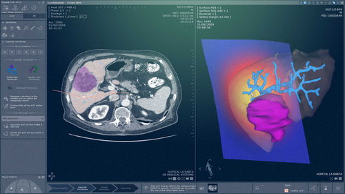 Analysis software module - MYRIAN®XP-LIVER MRI - Intrasense - diagnostic / evaluation / medical