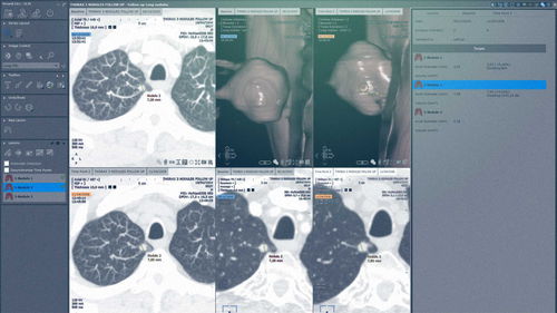 Analysis software module - MYRIAN®XP-LUNG NODULE - Intrasense - visualization / evaluation / treatment