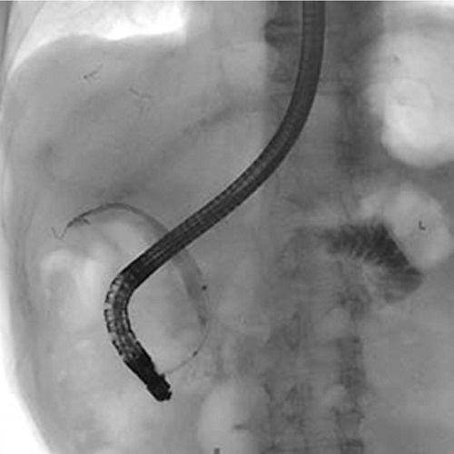 Endoscopic retrograde cholangiopancreatography software SUREengine