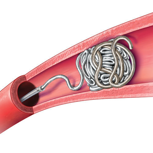 Occlusion catheter POD400™ Penumbra blood vessel