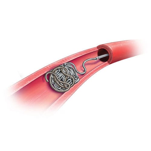 Peripheral catheter POD™ Penumbra