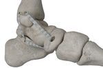 posterior tibial tendon ligament prosthesis
