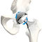 Cemented or non-cemented acetabular prosthesis - BiMobile - Waldemar Link