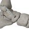 posterior tibial tendon ligament prosthesisInfinity-Lock&reg;Neoligaments
