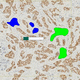 oncology software module / immunohistochemistry / for in situ fluorescence hybridization / visualization