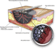 manual negative pressure wound therapy unit