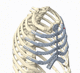 osteosarcoma resection reconstruction rib prosthesis