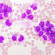 AML test kit / for MPN / oncology / for precision medicine