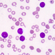 acute lymphoblastic leukemia test kit / oncology / for precision medicine / genetic