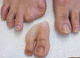 toe cosmetic prosthesis / adult