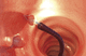intestinal polyp extraction endoscopic basket / straight