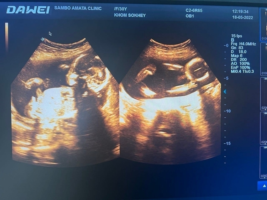 Dawei Ultrasound Machine Tips Xuzhou, Jiangsu, China Dawei Medical