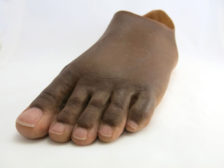 Partial foot prostheses by The Anaplastology Clinic - Beyond a simple foam  toe-filler - The Anaplastology Clinic