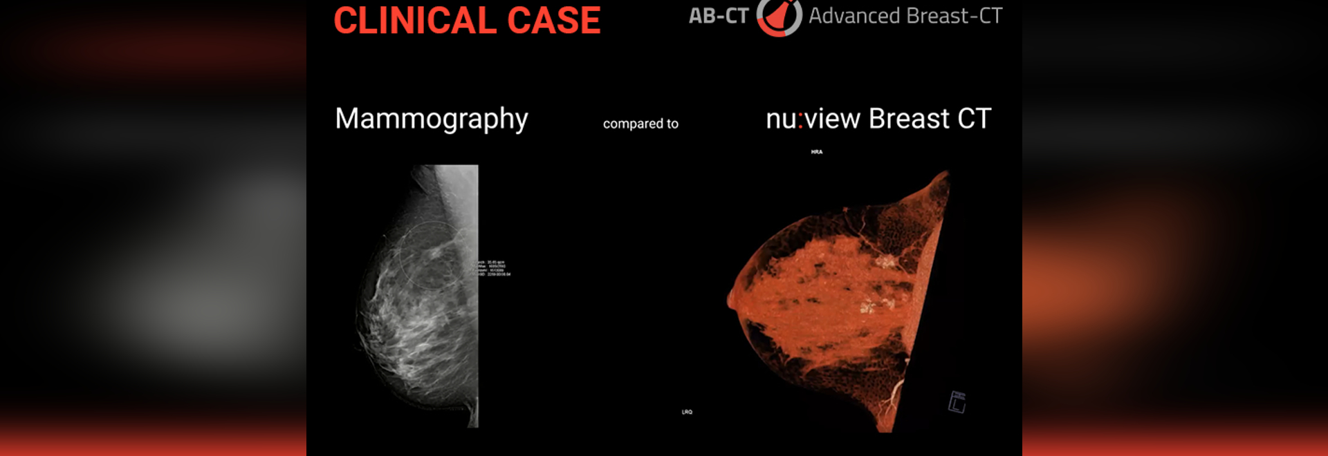 Clinical Case Comparison Between Mammography And Breast Ct Erlangen