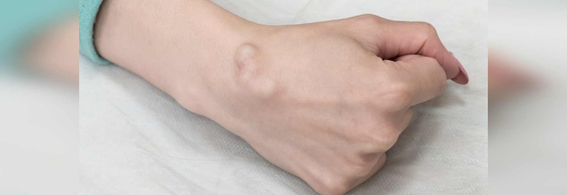 Ultrasoundguided Ganglion Cysts Assessment Los Angeles, CA, USA SIFSOF