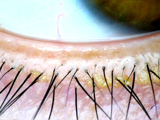 Blepharitis