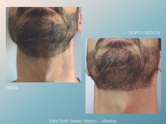 Before and After