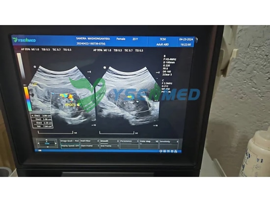 YSENMED YSB-M5 portable color doppler ultrasound working well in a Zimbabwean hospital.