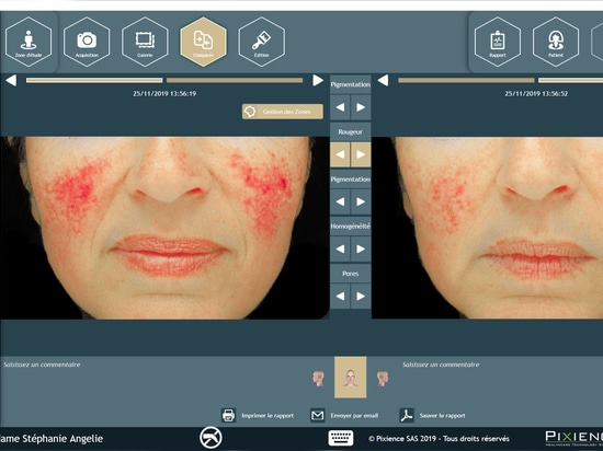 Macroscopic image - redness detection