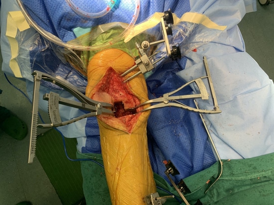 Shandong LiangMed Medical Gap Balancing Spreader With Circular Pad or Square pad