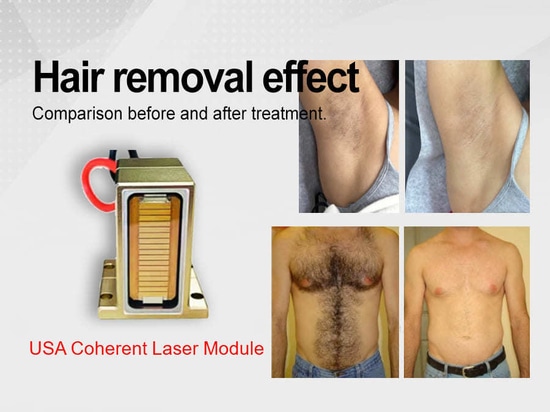 CJ-HR-1 highest power 3000W diode laser system for hair removal