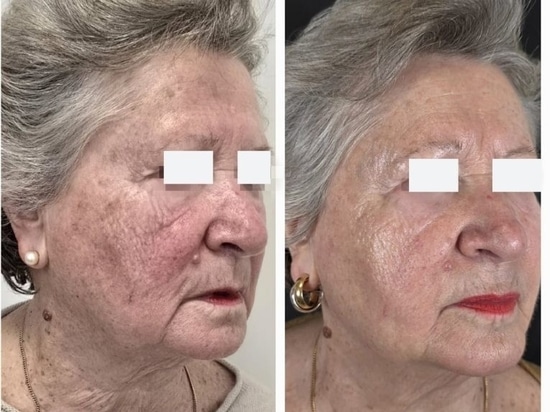 REVYPEEL®: The Next Generation of Needle-Free Bio-Revitalization