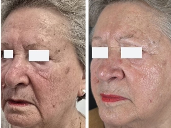 REVYPEEL®: The Next Generation of Needle-Free Bio-Revitalization