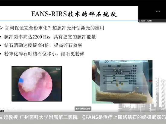 Wenqi Wu: Is the FANS the Ultimate Weapon for Treating Upper Urinary Tract Stones?